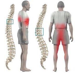 Ang kasakit nga adunay thoracic chondrosis mahimong ihatag sa ubos nga mga bukton ug crotch