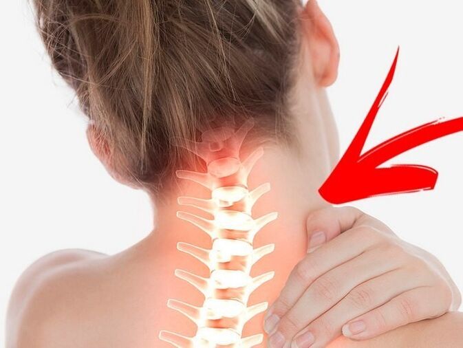 Ang pag-compress sa mga ugat sa nerbiyos nga adunay cervical osteochondrosis