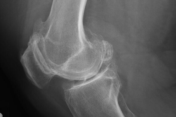 Mga pamaagi alang sa pagdayagnos sa arthrosis sa tuhod