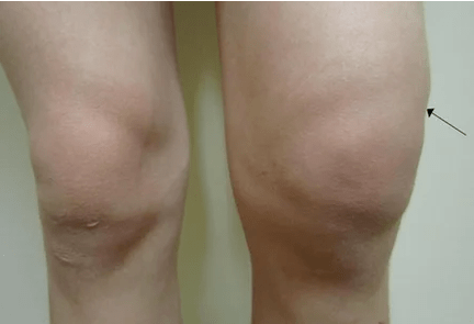 Hemarthrosis sa lutahan sa tuhod